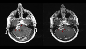 ΑΚΟΥΣΤΙΚΟ ΝΕΥΡΙΝΩΜΑ ΜΕΤΑ ΑΠΟ ΘΕΡΑΠΕΙΑ ΜΕ CYBERKNIFE - 3 & 9 MHNEΣ "ΜΕΤΕΓΧΕΙΡΗΤΙΚΑ"