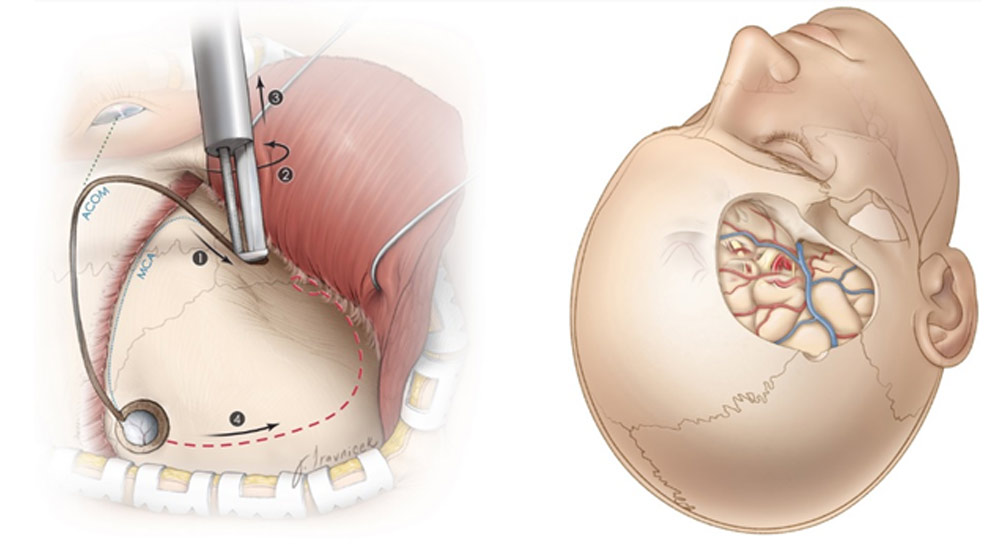 Υποσκληρίδιο Αιμάτωμα Χειρουργείο