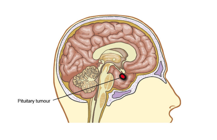 Αδένωμα Υπόφυσης Διάγνωση