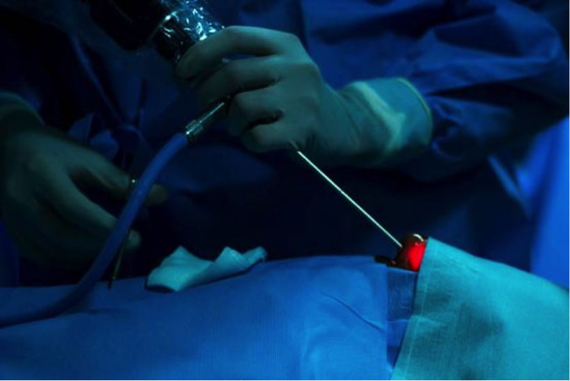 Αδένωμα Υπόφυσης Χειρουργείο