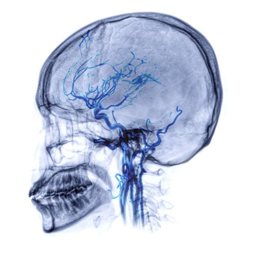Εγκεφαλική Αιμορραγία