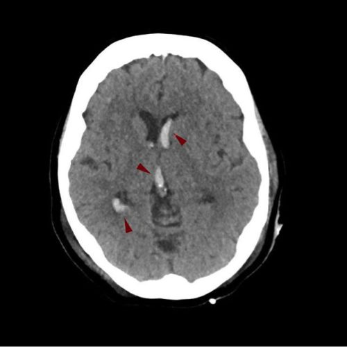 Ενδοκοιλιακή Αιμορραγία