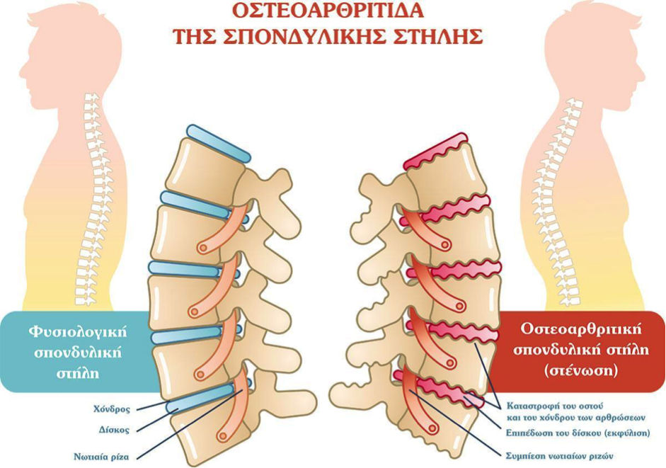Οστεοαρθρίτιδα της σπονδυλικής στήλης