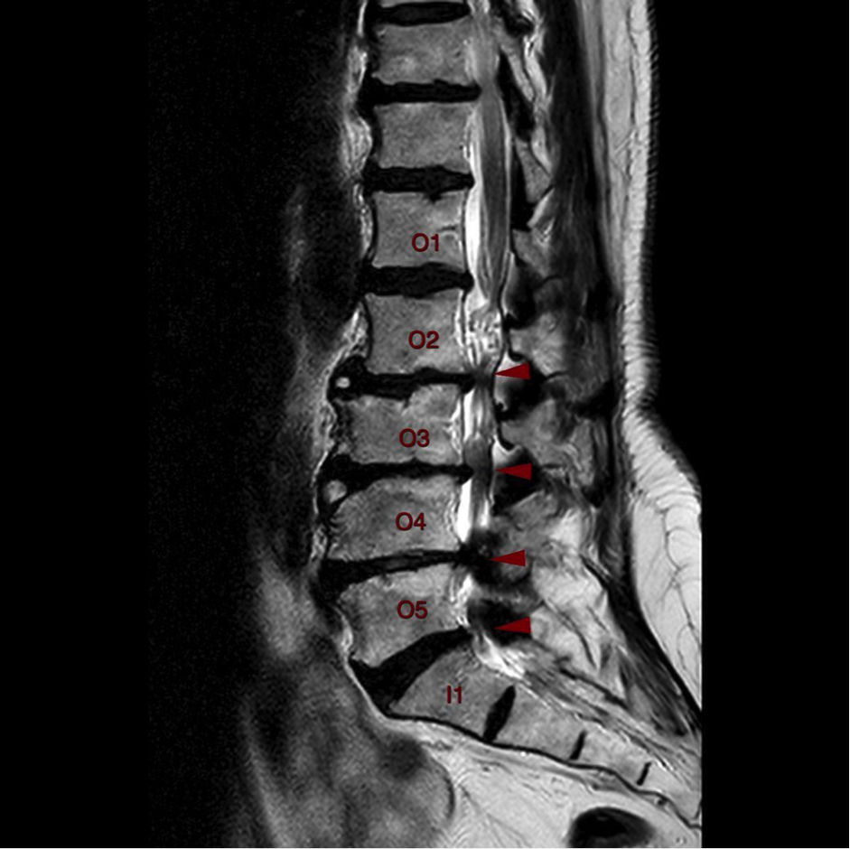 Σπονδυλική Στένωση