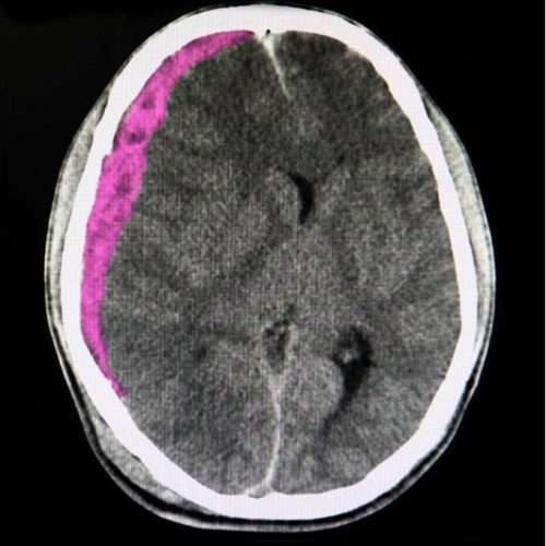 Υπο-επισκληρίδιο Αιμάτωμα